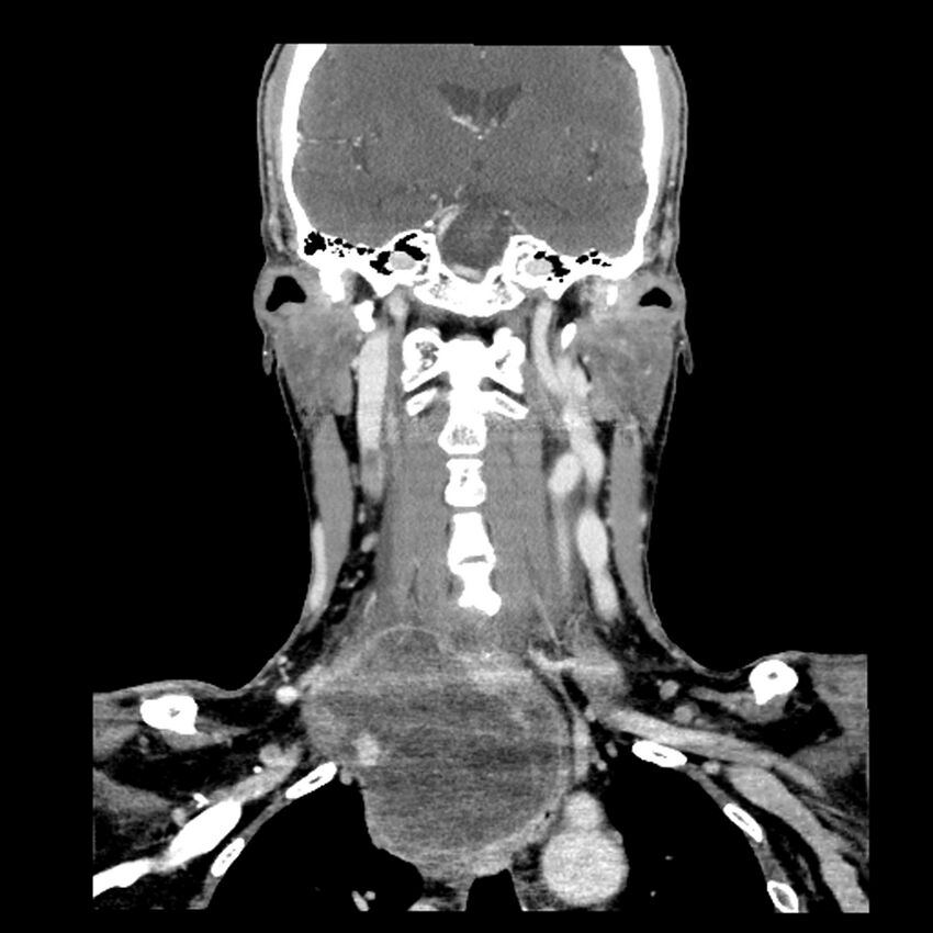 Anaplastic thyroid carcinoma (Radiopaedia 79087-92034 A 69).jpg