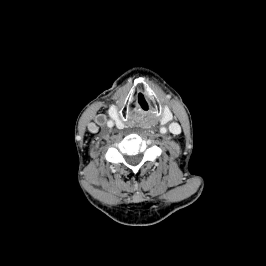 Anaplastic thyroid carcinoma (Radiopaedia 79087-92034 B 60).jpg