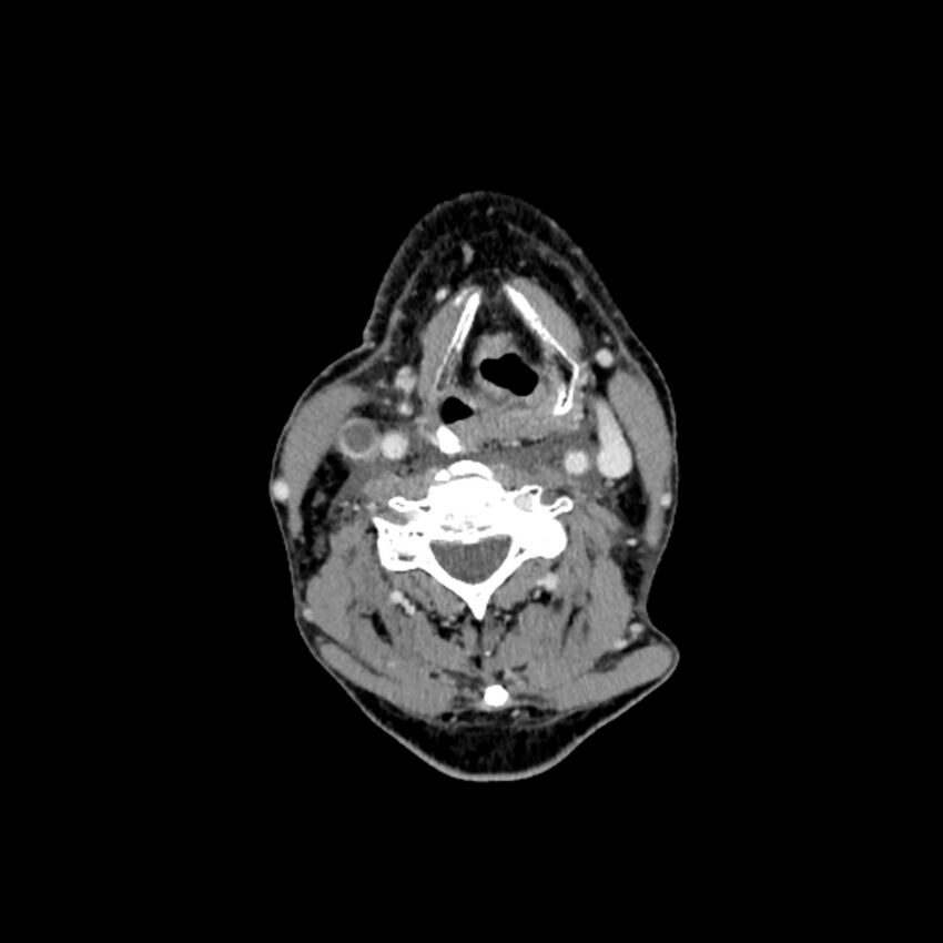 Anaplastic thyroid carcinoma (Radiopaedia 79087-92034 B 65).jpg