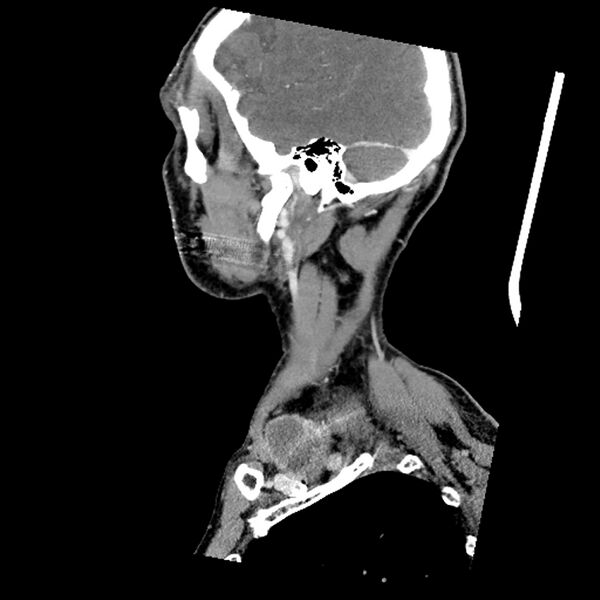 File:Anaplastic thyroid carcinoma (Radiopaedia 79087-92034 C 21).jpg