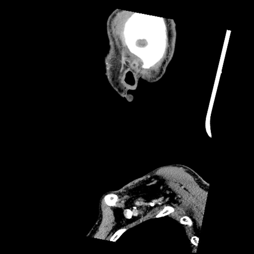 Anaplastic thyroid carcinoma (Radiopaedia 79087-92034 C 9).jpg