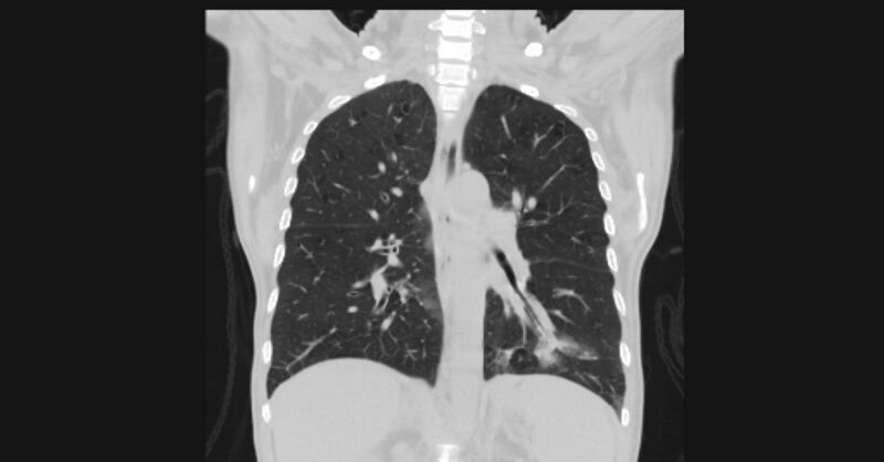 File:Angioinvasive aspergellosis (Radiopaedia 66995-76315 Coronal lung window 38).jpg