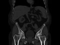 Ankylosing spondylitis (Radiopaedia 44609-48357 Coronal bone window 29).jpg