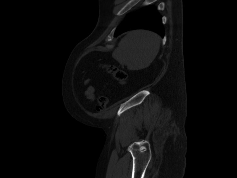 File:Ankylosing spondylitis (Radiopaedia 44609-48357 Sagittal bone window 101).jpg