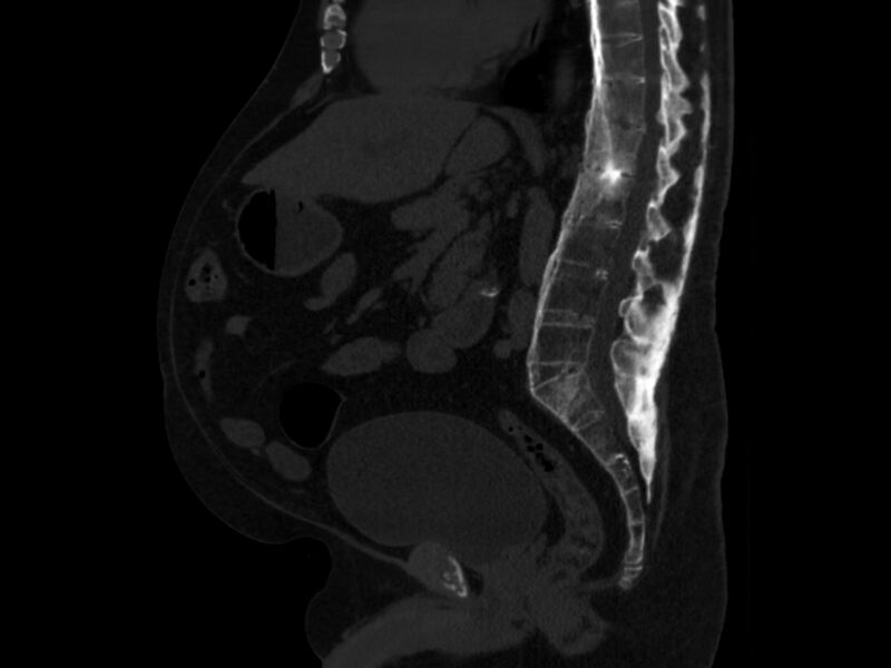 File:Ankylosing spondylitis (Radiopaedia 44609-48357 Sagittal bone window 54).jpg