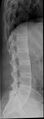 Ankylosing spondylitis (Radiopaedia 9152-9850 Lateral 1).jpg