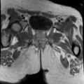Ano-vaginal fistula (Radiopaedia 29765-30284 Coronal T1 C+ 5).jpg