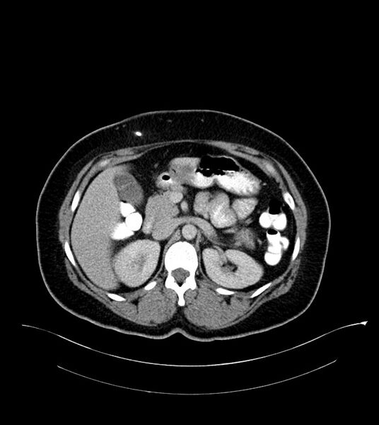 File:Anterior abdominal wall CSF pseudocyst (CSFoma) (Radiopaedia 79453-92571 A 34).jpg