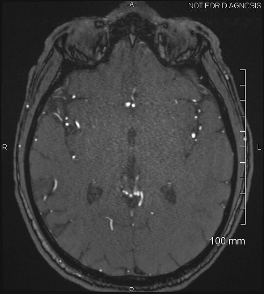 File:Anterior cerebral artery aneurysm (Radiopaedia 80683-94127 Axial MRA 123).jpg