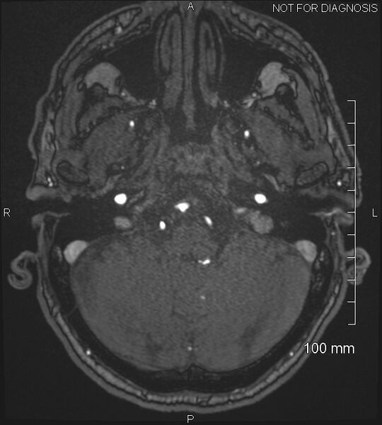 File:Anterior cerebral artery aneurysm (Radiopaedia 80683-94127 Axial MRA 39).jpg