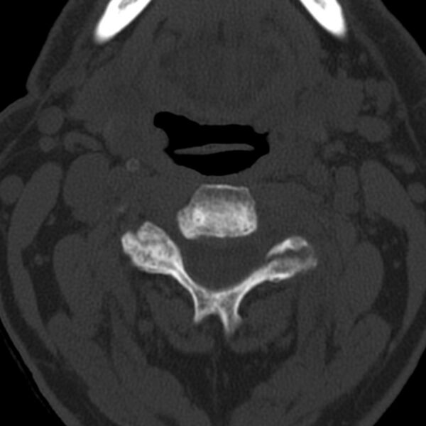 File:Anterior cervical postdiscectomy arthrodesis (Radiopaedia 32678-33646 Axial bone window 30).jpg