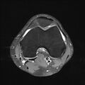 Anterior cruciate ligament full thickness tear (Radiopaedia 66268-75467 Axial PD fat sat 12).jpg