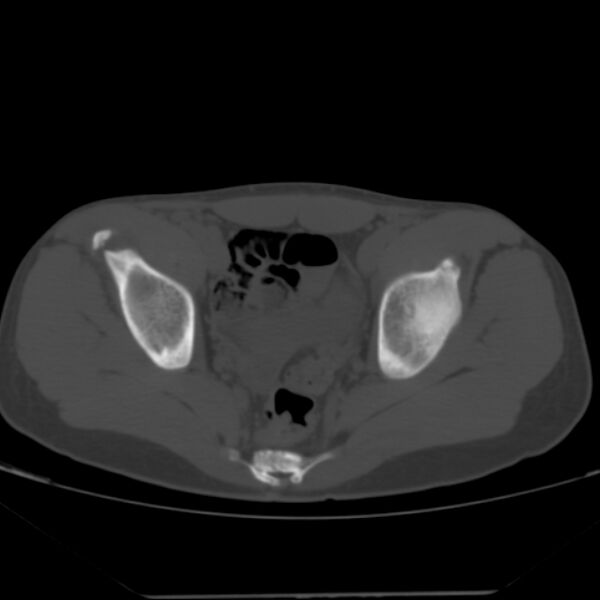 File:Anterior inferior iliac spine avulsion fracture (Radiopaedia 49469-54627 Axial bone window 31).jpg