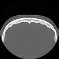 Antrochoanal polyp (Radiopaedia 15098-14982 Axial non-contrast 35).jpg