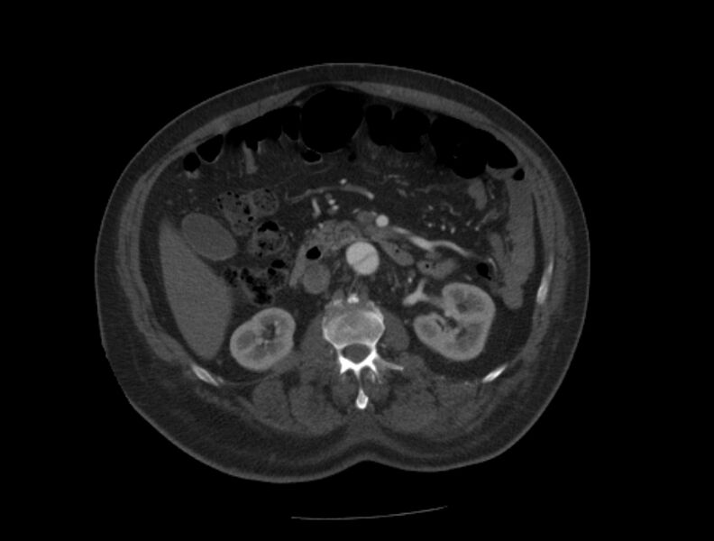 File:Aortic dissection (Radiopaedia 28802-29105 A 58).jpg