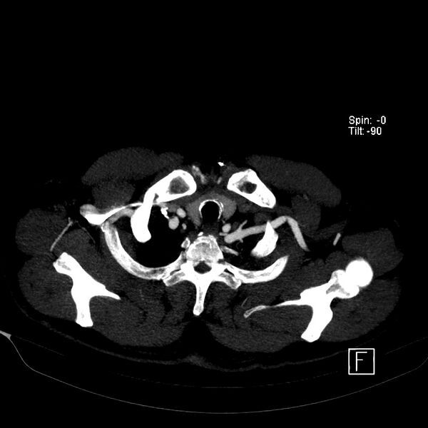 File:Aortic dissection - De Bakey type III - Stanford B (Radiopaedia 21903-21882 B 7).jpg