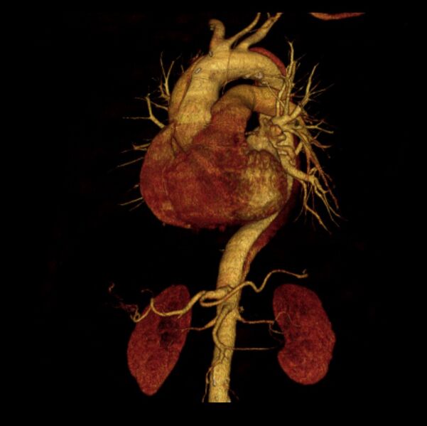 File:Aortic dissection with rupture into pericardium (Radiopaedia 12384-12647 D 35).jpg