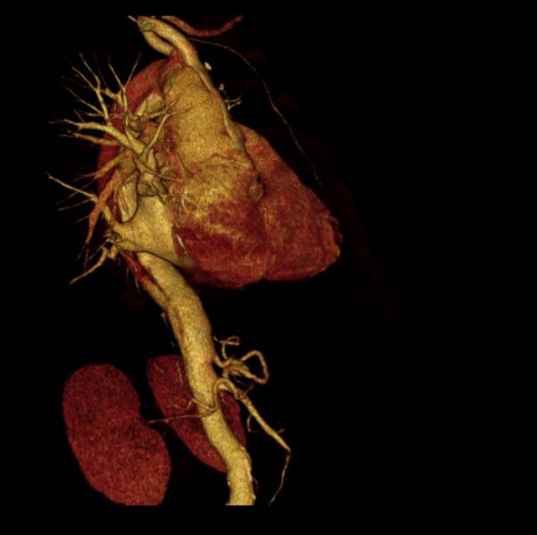 File:Aortic dissection with rupture into pericardium (Radiopaedia 12384-12647 D 8).jpg