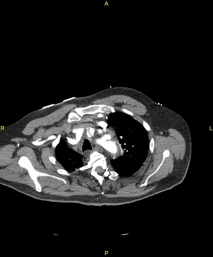 Aortic rupture (Radiopaedia 88822-105594 B 47).jpg