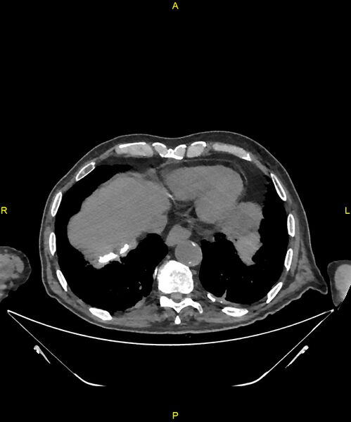 File:Aortoenteric fistula (Radiopaedia 84308-99603 Axial non-contrast 14).jpg