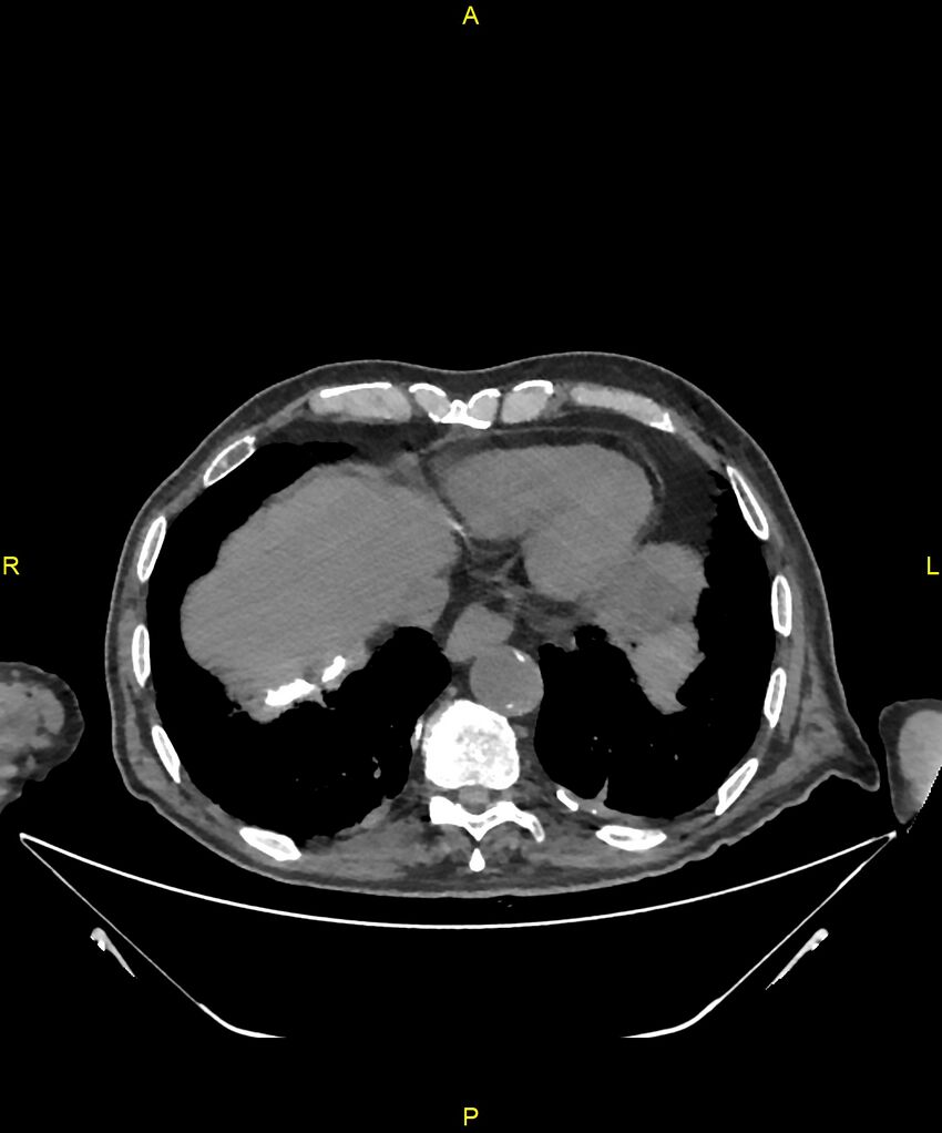 Aortoenteric fistula (Radiopaedia 84308-99603 Axial non-contrast 14).jpg