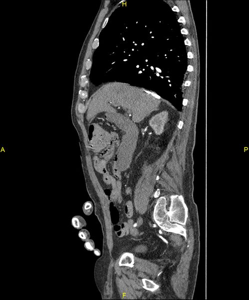 File:Aortoenteric fistula (Radiopaedia 84308-99603 C 125).jpg
