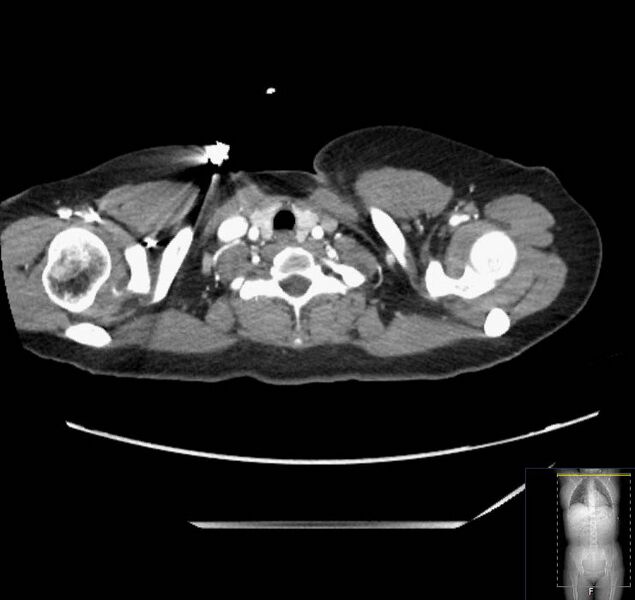 File:Appendicitis (CT angiogram) (Radiopaedia 154713-127660 Axial 244).jpg