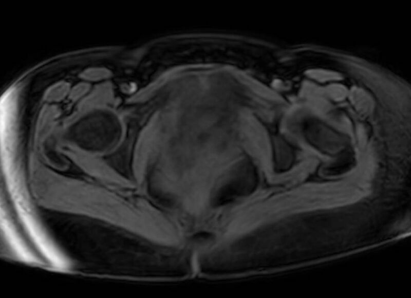 File:Appendicitis in gravida (MRI) (Radiopaedia 89433-106395 Axial DIXON 146).jpg