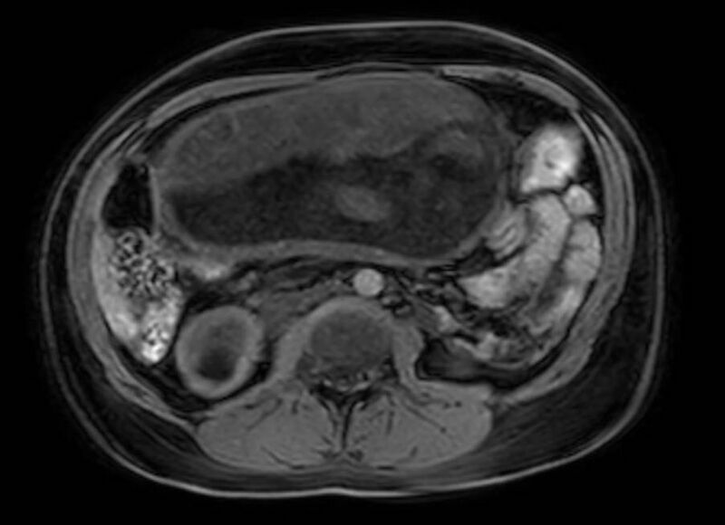 File:Appendicitis in gravida (MRI) (Radiopaedia 89433-106395 Axial DIXON 63).jpg