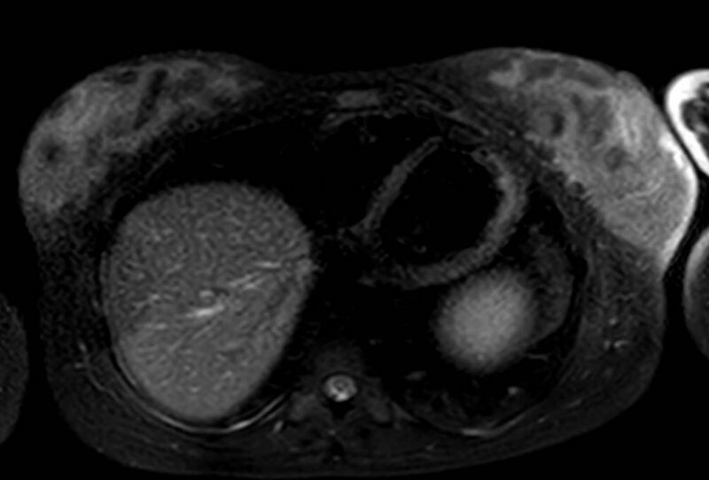 File:Appendicitis in gravida (MRI) (Radiopaedia 89433-106395 Axial T2 SPAIR 5).jpg