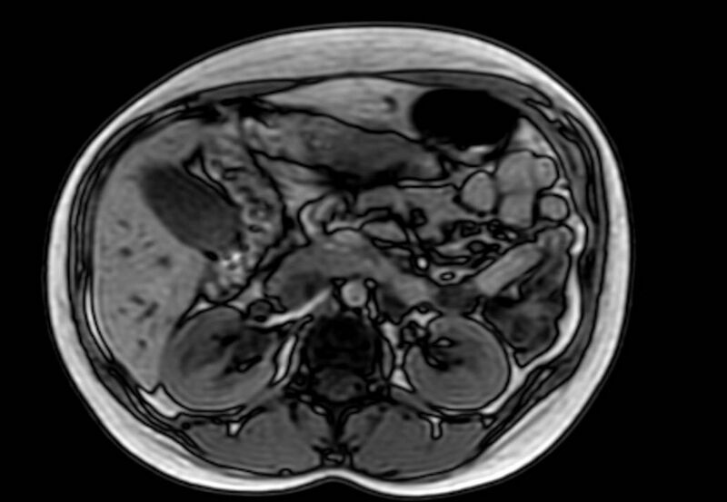 File:Appendicitis in gravida (MRI) (Radiopaedia 89433-106395 D 23).jpg