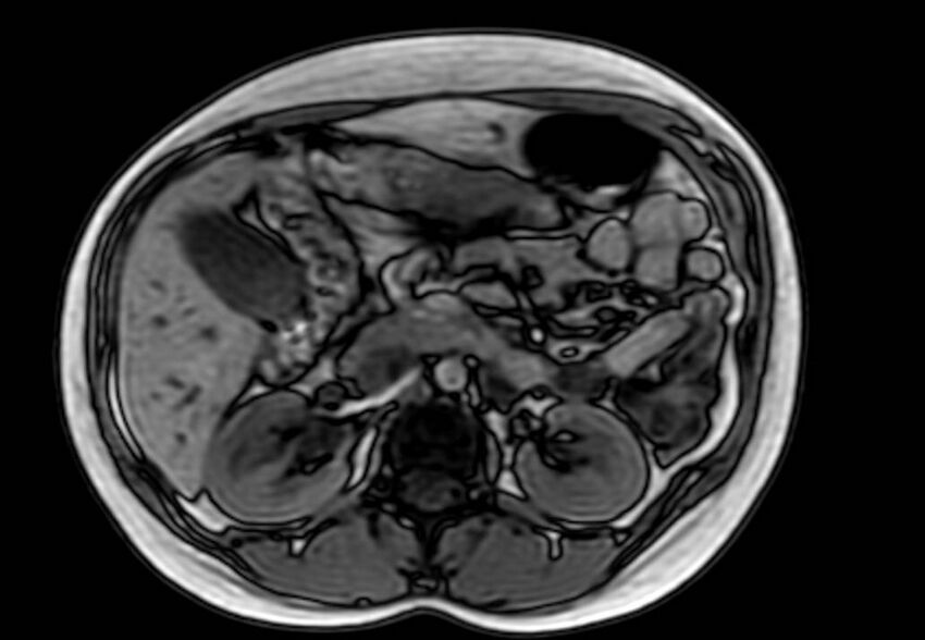 Appendicitis in gravida (MRI) (Radiopaedia 89433-106395 D 23).jpg