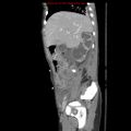 Appendicitis with phlegmon (Radiopaedia 9358-10046 F 14).jpg