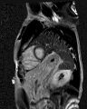 Arrhythmogenic right ventricular cardiomyopathy (Radiopaedia 57972-64966 D 10).jpg