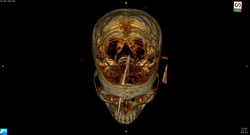 File:Arrow injury to the brain (Radiopaedia 72101-82607 3D bone 16).jpg