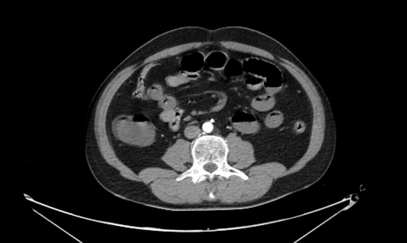 File:Arterial occlusive mesenteric ischemia (Radiopaedia 84641-100060 A 72).jpg