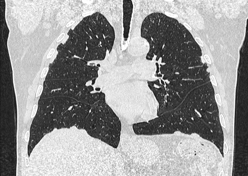 File:Asbestos pleural placques (Radiopaedia 57905-64872 Coronal lung window 140).jpg