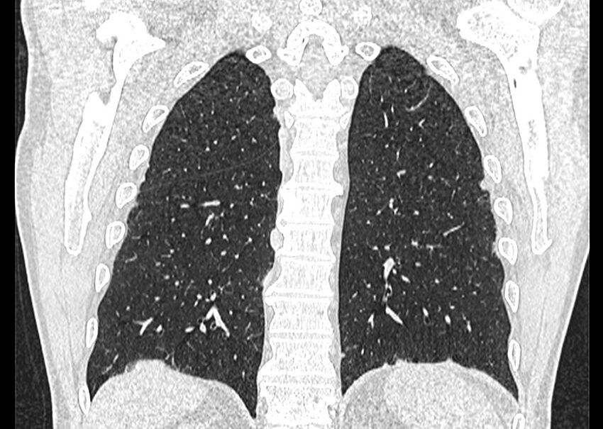 Asbestos pleural placques (Radiopaedia 57905-64872 Coronal lung window 224).jpg