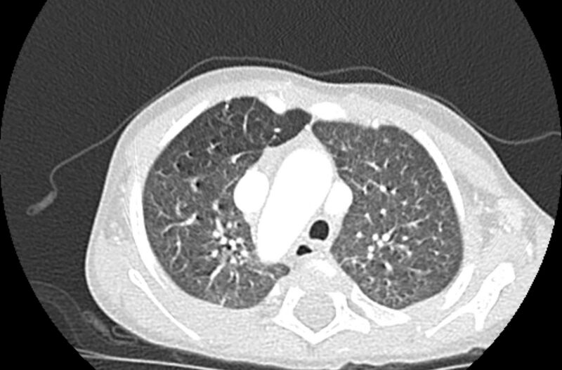 File:Asplenia syndrome (Radiopaedia 73083-83792 Axial lung window 18).jpg