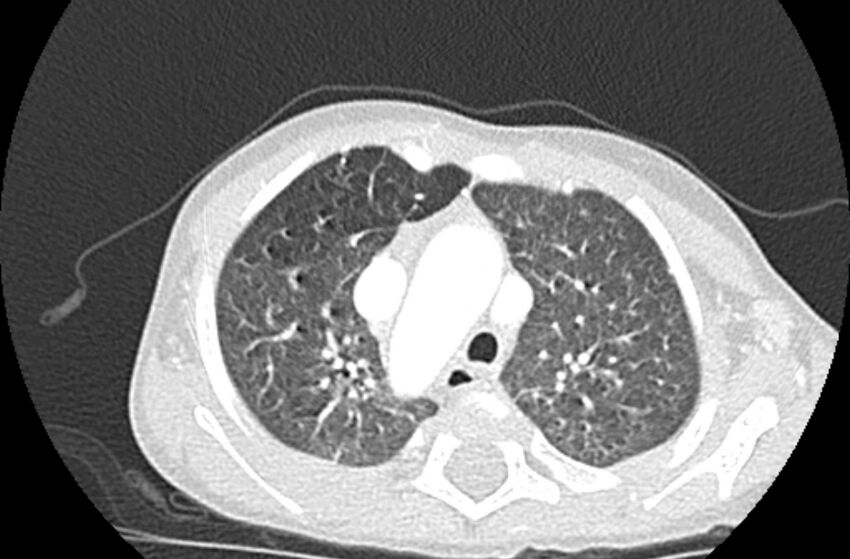 Asplenia syndrome (Radiopaedia 73083-83792 Axial lung window 18).jpg