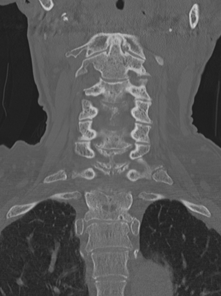 File:Atlanto-axial subluxation (Radiopaedia 36610-38176 Coronal bone window 23).png