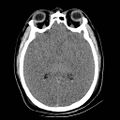 Atlanto-occipital dislocation (Radiopaedia 44648-48412 Axial non-contrast 28).jpg