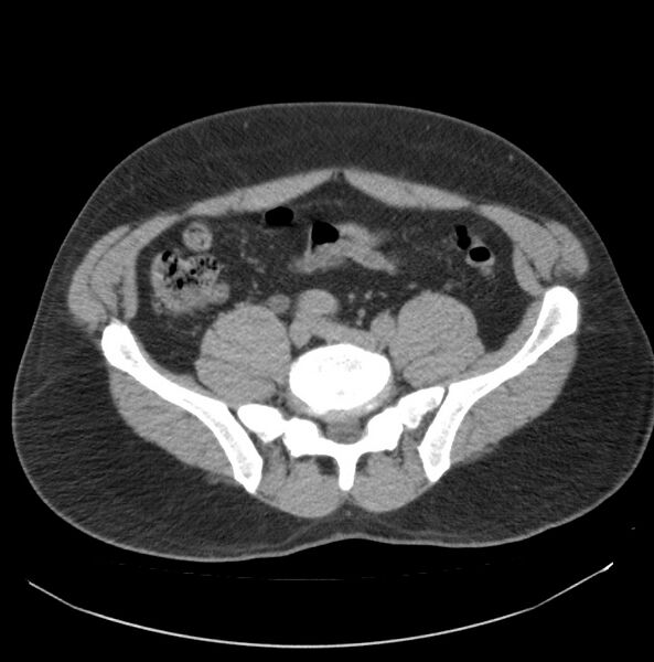 File:Atrophic kidney due to severe chronic obstructive hydronephrosis (Radiopaedia 40828-43474 Axial non-contrast 27).jpg