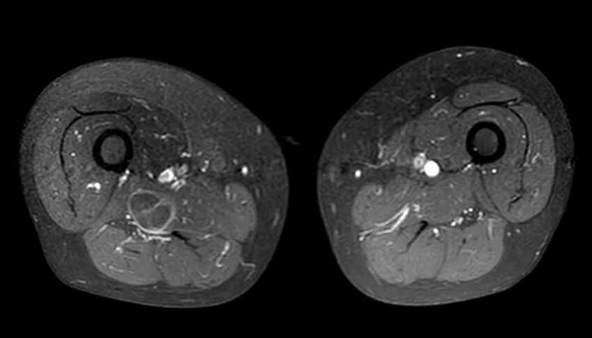 Atypical lipomatous tumor - thigh (Radiopaedia 68975-78734 Axial T1 C+ fat sat 48).jpg