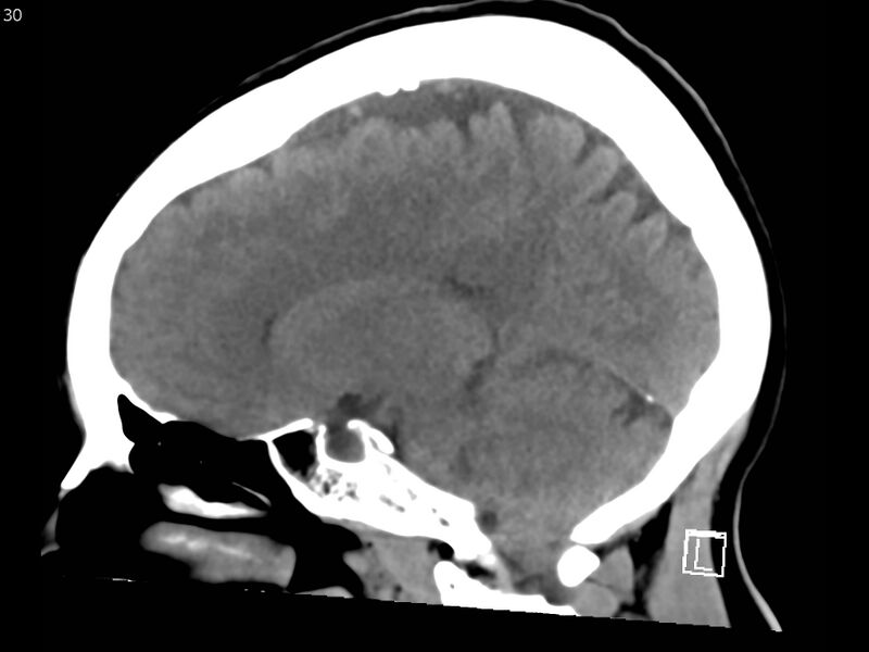 File:Atypical meningioma - intraosseous (Radiopaedia 64915-73867 C 28).jpg