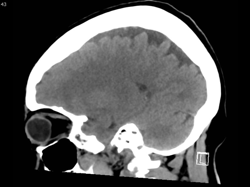 Atypical meningioma - intraosseous (Radiopaedia 64915-73867 C 41).jpg