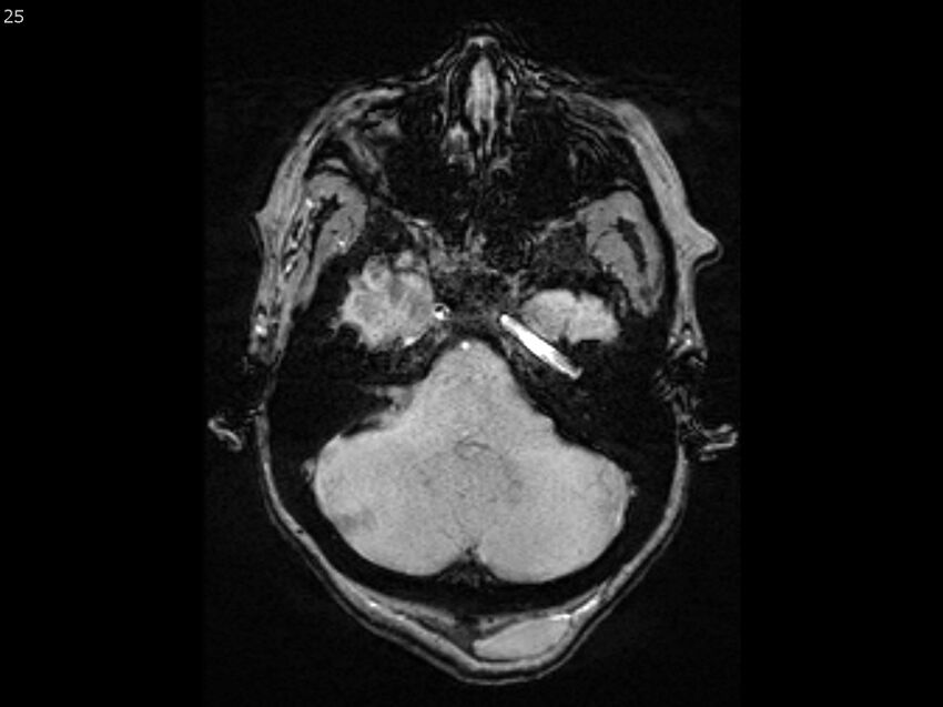 Atypical meningioma - intraosseous (Radiopaedia 64915-74572 Axial SWI 25).jpg