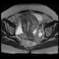 Atypical retroperitoneal lymphocoeles with large leiomyoma of uterus (Radiopaedia 32084-33027 Axial T2 22).jpg