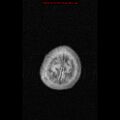 Atypical teratoid rhabdoid tumor (Radiopaedia 10712-11183 Axial FLAIR 1).jpg