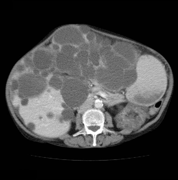 File:Autosomal dominant polycystic kidney disease (Radiopaedia 16777-16490 A 30).jpg